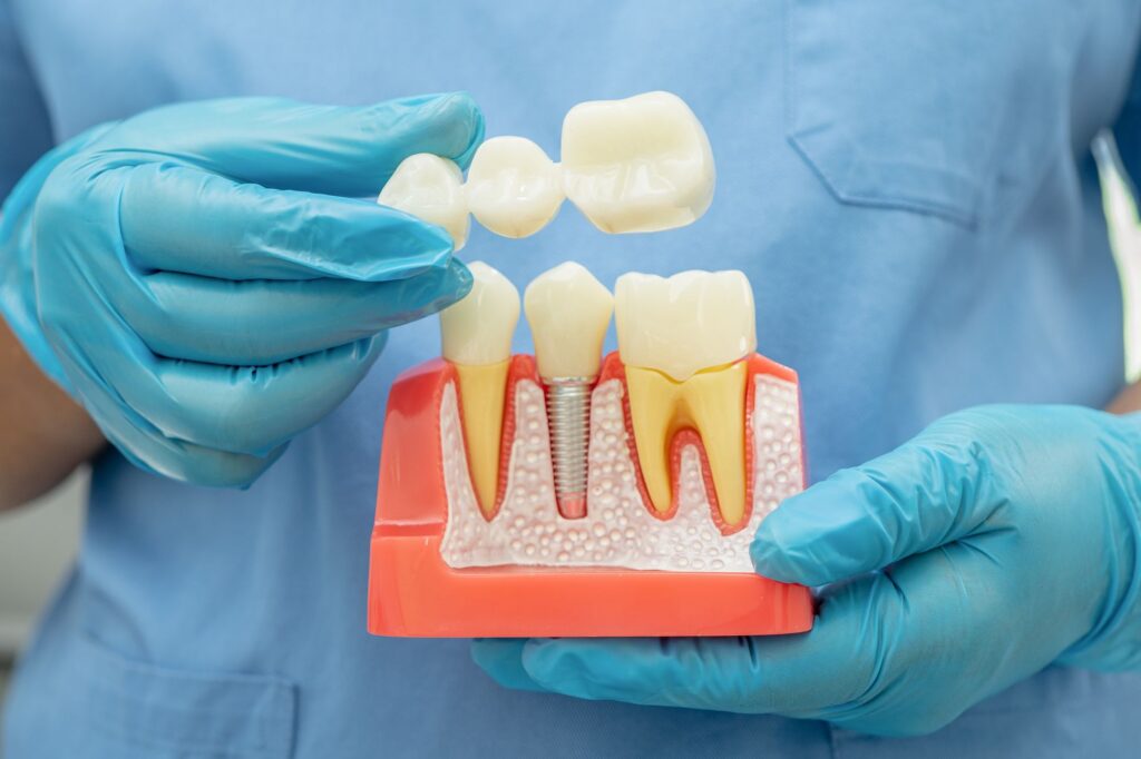 dental implant artificial tooth roots into jaw